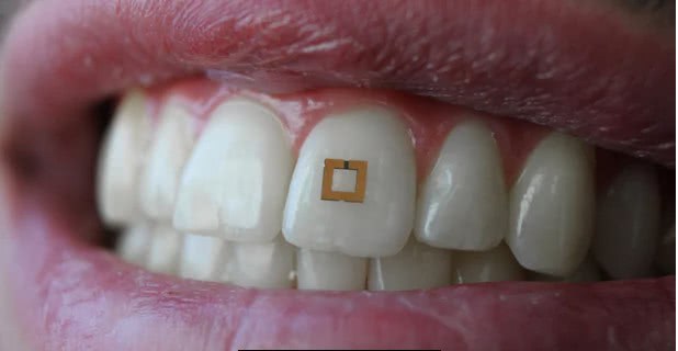在牙齿上安个微感测器可以监测你摄入的葡萄糖、盐量和酒精量