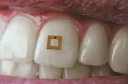 不可思议这种装在牙齿上的食物感测器可以传递各种饮食数据