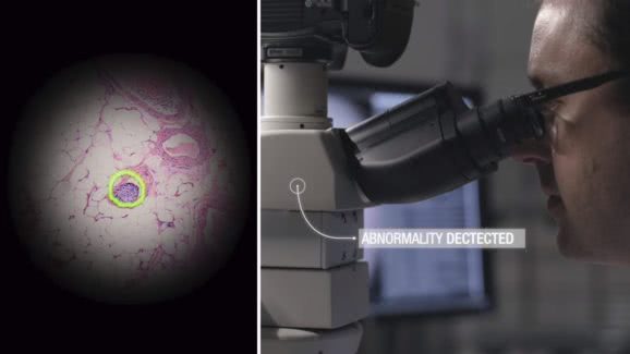 谷歌推出AR显微镜可利用机器学习技术迅速发现癌细胞