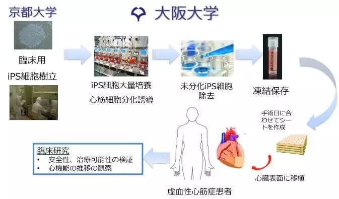 日本年内开始心脏疾患的iPS细胞临床试验