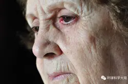 美科学家提出老年痴呆致病新假说 疱疹病毒入侵可能是主要原因