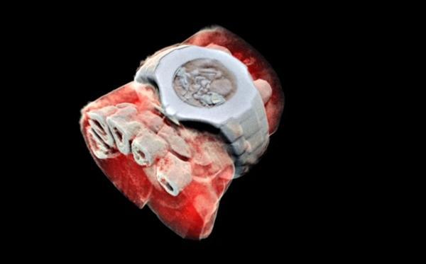 新西兰科学家研发出3D彩色X光技术人体内部结构清晰可见