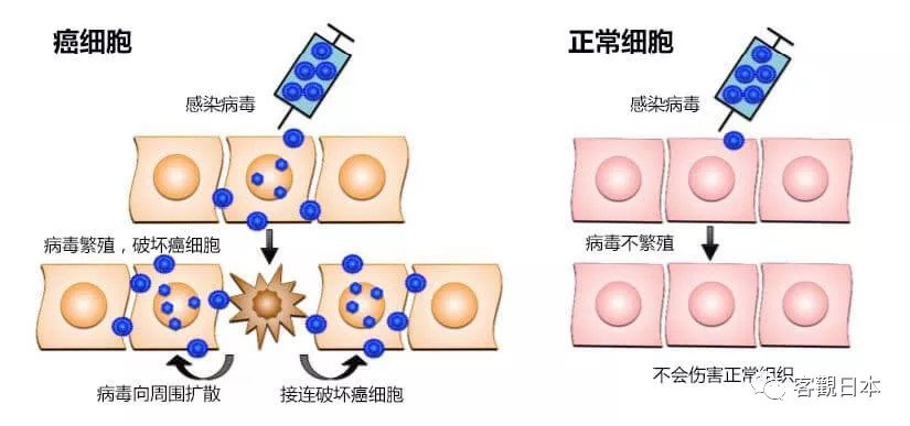 用病毒治疗恶性间皮瘤 日本开始临床试验