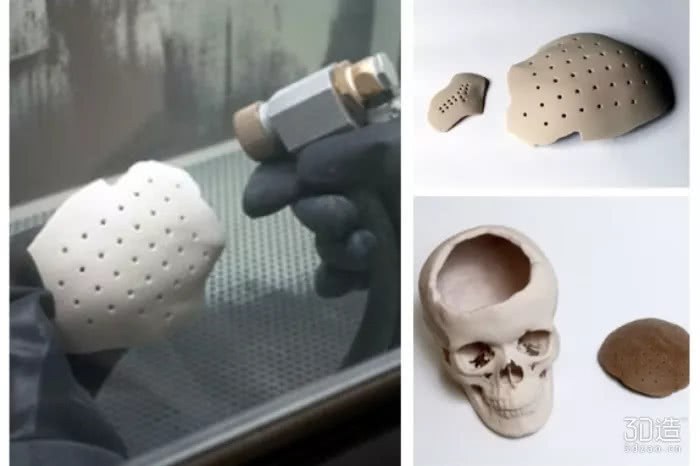 俄罗斯3D打印出能让颅骨快速恢复生长的骨植入物