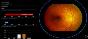 AI前进印度眼科医院第一线，Google用深度学习及早发现7千万糖尿病患的失明危机
