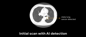 Google打造肺癌预测模型，表现超越人类放射科医师