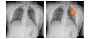 Google训练深度学习模型判读多种肺部X光片病征