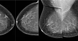 DeepMind AI系统检测乳癌准确度超过专家，可大幅降低X光照片解读工作负担